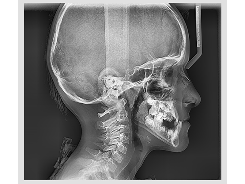 Трг черепа в боковой. Телерентгенограмма черепа (ТРГ). Снимок ТРГ В боковой проекции. ТРГ мезиальная окклюзия.